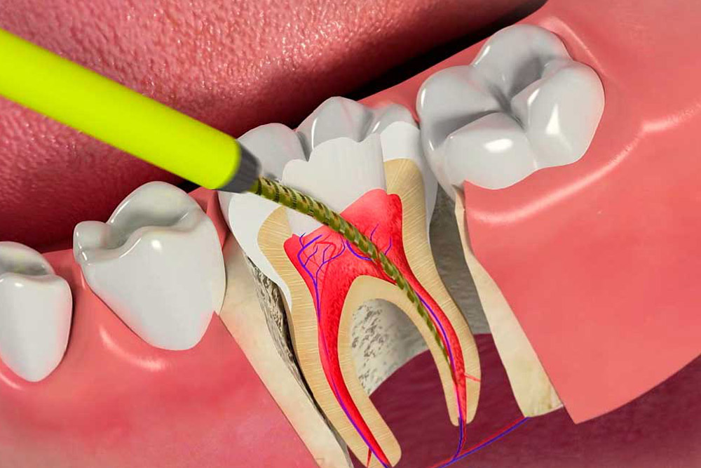 Пломбирование корневых каналов зуба