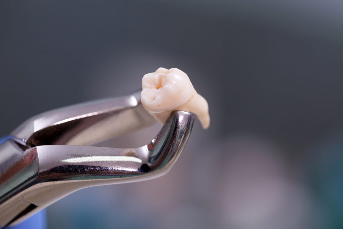 Удаление сложных зубов