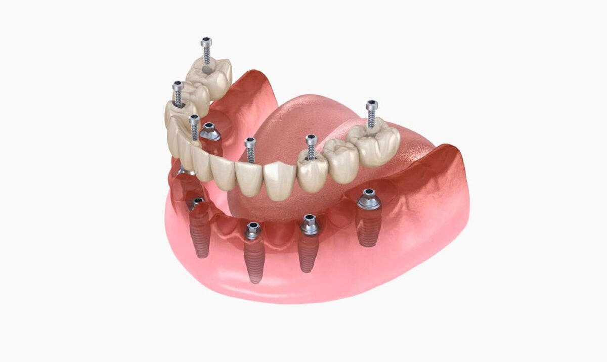 Протезирование челюсти при отсутствии зубов